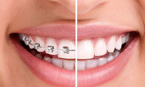 Best Orthodontic Treatment in Nagpur