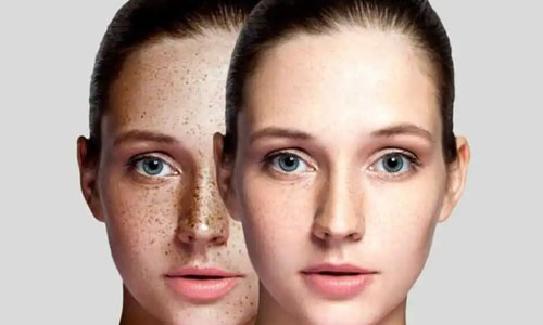 Freckles Treatment in Nagpur