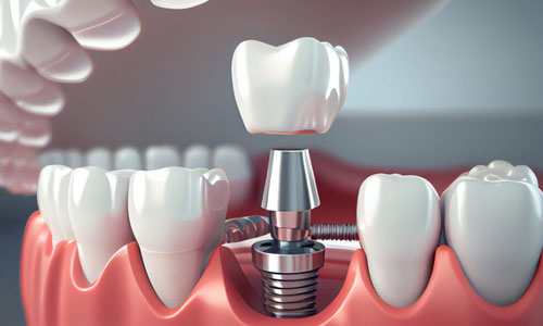 Dental Implants