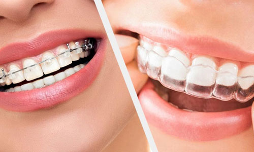 Orthodontic Treatment