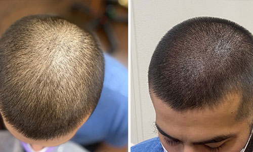 Scalp Micro Pigmentation