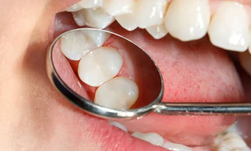 Tooth Color Filling