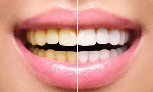 Tooth Whitening