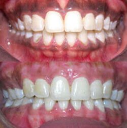 Depigmentation Depigmentation