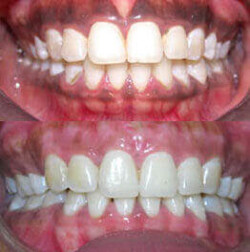 Depigmentation Depigmentation