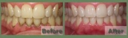 Scaling / Tooth Cleaning Scaling / Tooth Cleaning