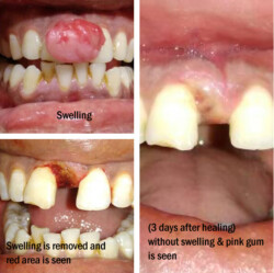 3 days after healing 3 days after healing