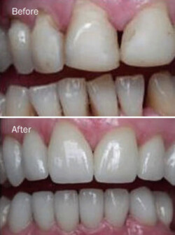 Tooth Bleaching Tooth Bleaching