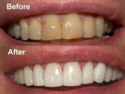 Tooth Bleaching Tooth Bleaching