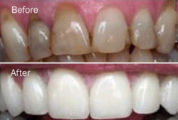 Tooth Bleaching Tooth Bleaching