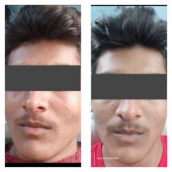 Acne Reduction
