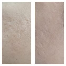 Micro Needling