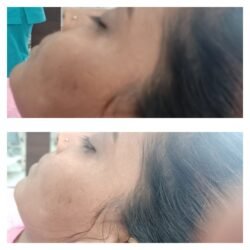 Whitening Peel