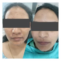 Acne Reduction