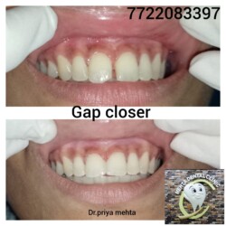 Gap Closer Gap Closer