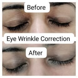 Eye Wrinkle Correction