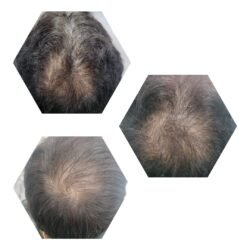 Hair Regrowth by Laser Helmet