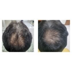 Hair Treatment