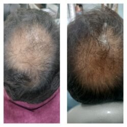 Hair Treatment