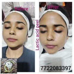 Lactic Acid Peel