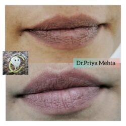 Lip Micro Pigmentation