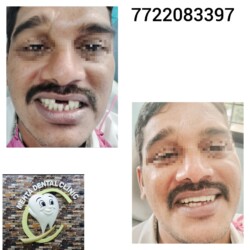 Missing Teeth Missing Teeth