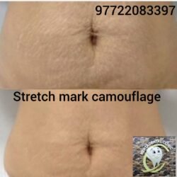 Stretch Mark Camourflage